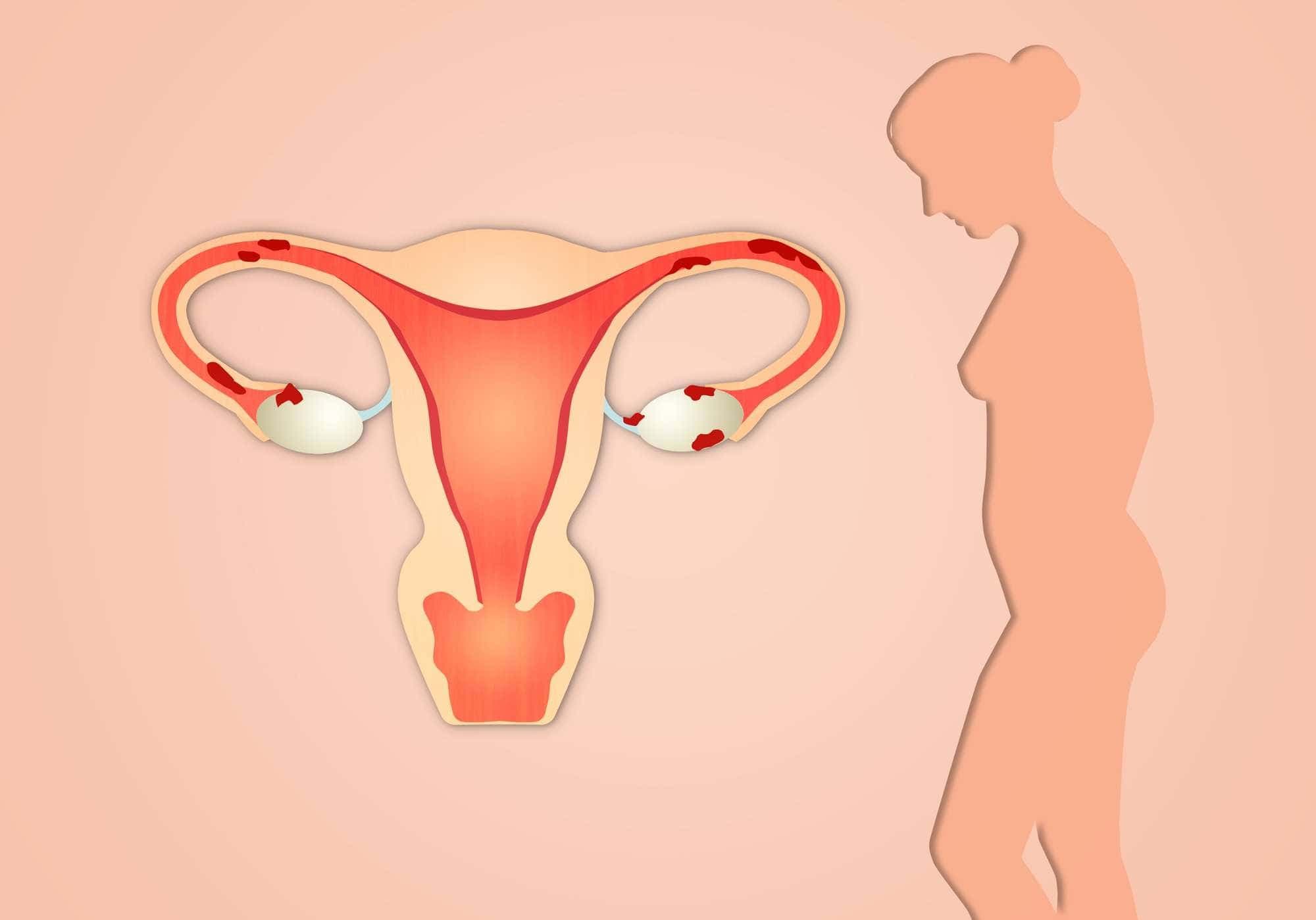 Endometriosis: Everything You Need to Know